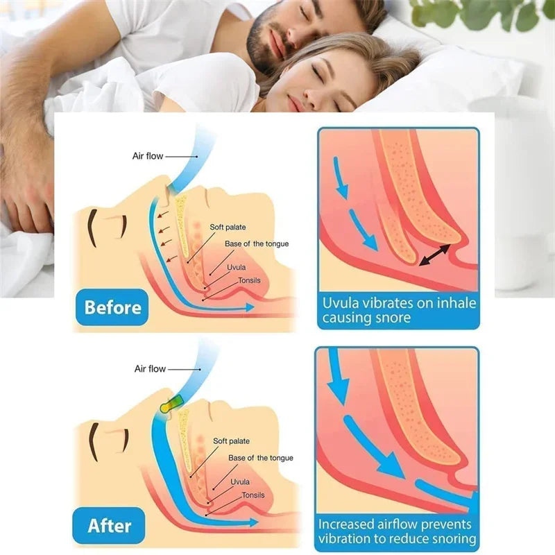 Anti-Snoring Corrector